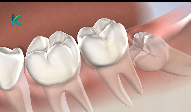 Wisdom Teeth Removal Jeffersonville In